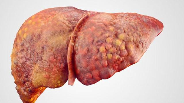 第一步先伤害肝脏健康,导致肝功能异常,从而诱发脂肪肝,之后也容易